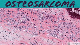 Osteosarcoma 101 Bone Pathology Basics [upl. by Nessie]