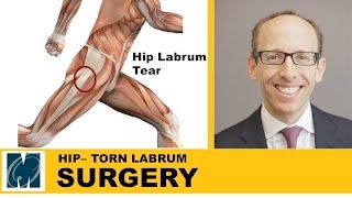 Hip Pain  Torn Labrum Hip [upl. by Ybloc69]