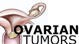 Ovarian Pathology amp Tumors [upl. by Octave]