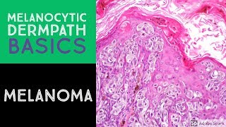 Melanocytic Dermpath Basics Melanoma [upl. by Jennette]