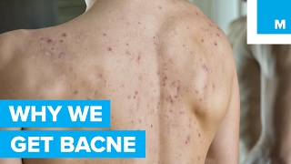 The Science Behind Why “Bacne” Happens to Good People  Sharp Science [upl. by Ammej]