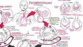 Emphysema  Pathophysiology COPD [upl. by Drawyah265]