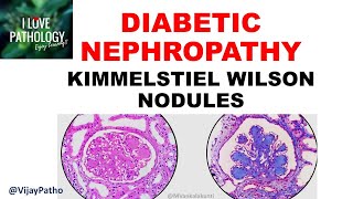 DIABETIC NEPHROPATHY Pathophysiology amp Morphology [upl. by Anirrok]