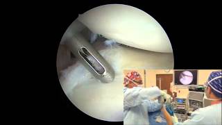 Arthroscopic Posterior Labral Repair  Randy S Schwartzberg MD [upl. by Hersch842]