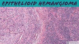 Epithelioid Hemangioma aka ALHE 5Minute Pathology Pearls [upl. by Eicats]