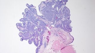 Bladder Cancer  Pathology mini tutorial [upl. by Dahsra]