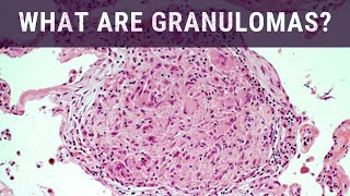 What are Granulomas  Pathology mini tutorial [upl. by Cogn]