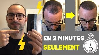 Greffe de cheveux  Le REMÈDE ANTICHUTE de Cheveux PostIntervention 😱 [upl. by Krall]