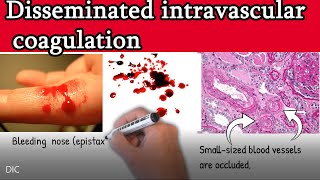 Disseminated intravascular coagulation DIC  Causes Symptoms Treatment and prognosis [upl. by Hadsall396]