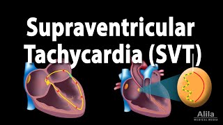 Supraventricular Tachycardia SVT PSVT Animation [upl. by Acinnej906]