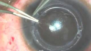 Intacs Insertion for Keratoconus [upl. by Healion]