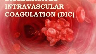 Disseminated Intravascular Coagulation [upl. by Eissolf925]