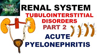 ACUTE PYELONEPHRITIS Pathology [upl. by Enilreug]