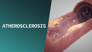 Atherosclerosis  Pathologies [upl. by Atirat447]