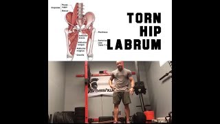 SLAP Tears and Labrum Tears  Should You Get Shoulder Surgery [upl. by Sidalg]