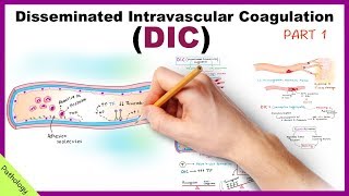 DIC Disseminated Intravascular Coagulation  Part 1 [upl. by Thorma]