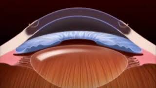 Cornea transplant [upl. by Nyllij]