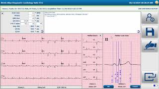 Welch Allyn® Diagnostic Cardiology Suite™ Physician Tools for Resting ECGs [upl. by Strawn7]